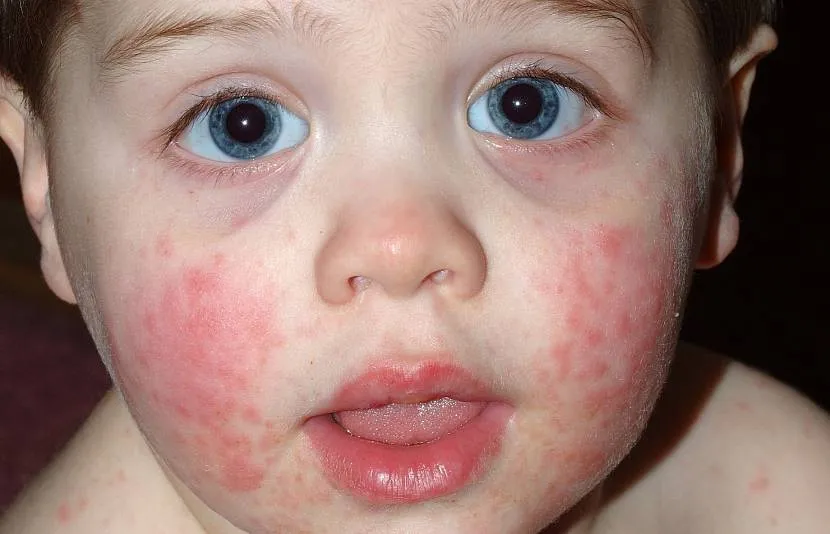 Алергія на мідний купорос у дитини після купання у басейні